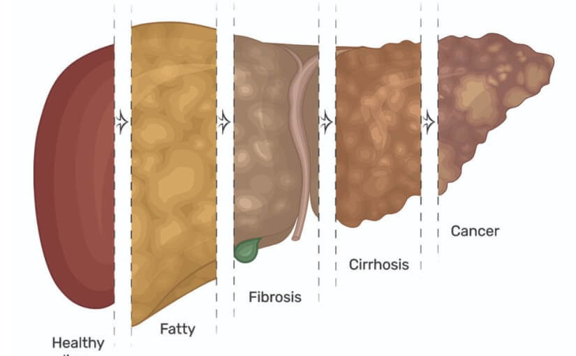 fATTY-LIVER-825x510