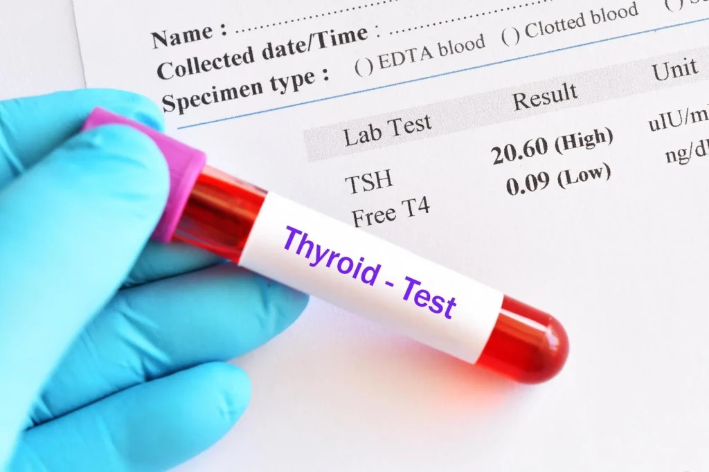 hypothyroidism-result-with-blood-sample-tube